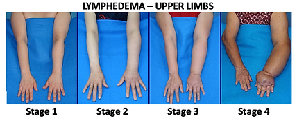 Lymphedema Upper Limbs