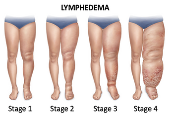 Lymphedema