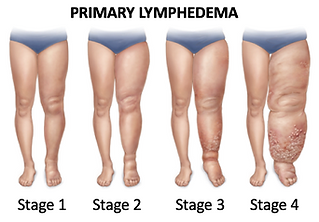 Primary Lymphedema