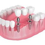 implant supported bridge.jpeg