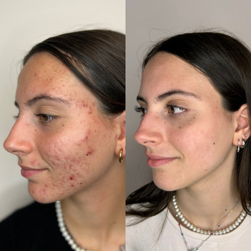 Foto prima e dopo trattamento dermatologico per acne giovanile, eseguito dalla dottoressa Virginia Garofalo a Roma con risultati visibili su pelle del viso