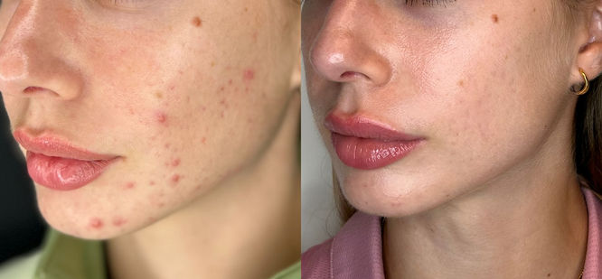 Foto prima e dopo trattamento dermatologico per acne giovanile, eseguito dalla dottoressa Virginia Garofalo a Roma con risultati visibili su pelle del viso