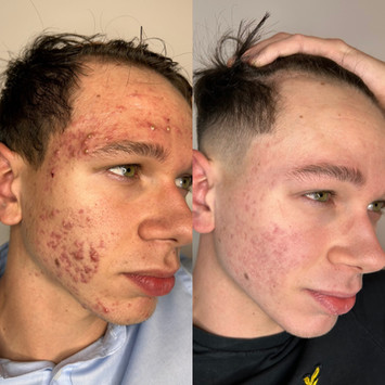 Foto prima e dopo trattamento dermatologico per acne giovanile, eseguito dalla dottoressa Virginia Garofalo a Roma con risultati visibili su pelle del viso