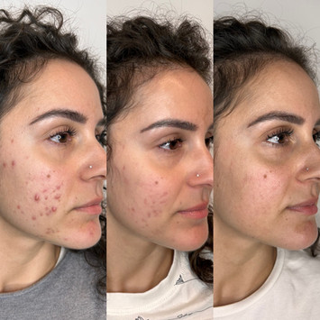 Foto prima e dopo trattamento dermatologico per acne giovanile, eseguito dalla dottoressa Virginia Garofalo a Roma con risultati visibili su pelle del viso