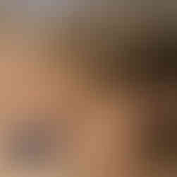 Injury on the Hatcho trail 八丁コース on Mount Ryogami ( ryōgami ryogami-san 両神山 )