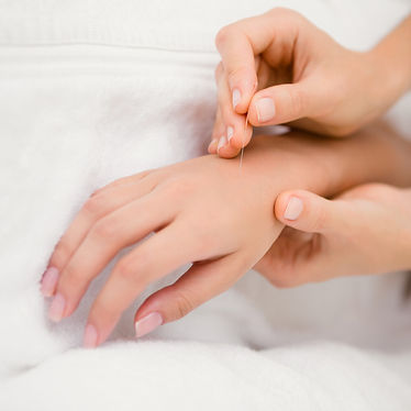 Akupunktur -Arthrose