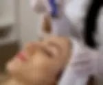 Professional Microneedling Treatment