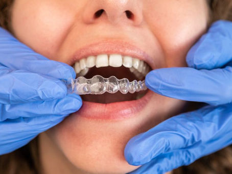 How Does Invisalign Work? A Step-by-Step Breakdown of the Treatment Process