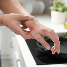 Burns: a simple guide to identifying and treating them
