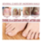 Thumbnail: Anti Paronychia Relief Oil Ingrown Toenail Drops Anti Fungal Toe Nail Ingrown C