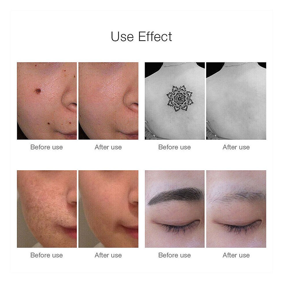 Thumbnail: Laser Spot Remover Machine Red Light Therapy Blue Light Therapy Tattoo Scar Mol