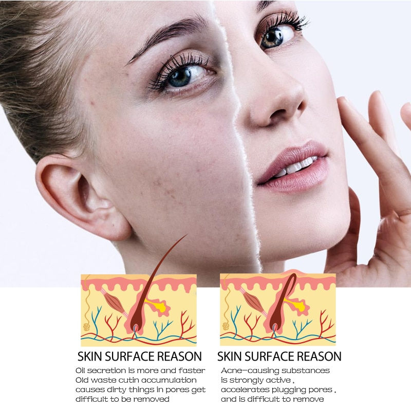 Thumbnail: Salicylic Acid Shrink Pores Facial Serum Firm Moisturizing Essence Liquid Repai