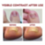 Thumbnail: Anti Paronychia Relief Oil Ingrown Toenail Drops Anti Fungal Toe Nail Ingrown C
