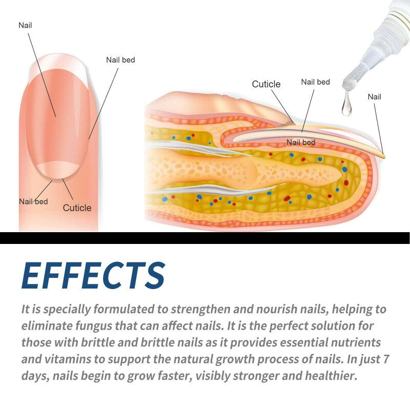 Thumbnail: Anti Fungal Nails Repair Gel Onychomycosis Infection Repair Bleeding Yellowing 