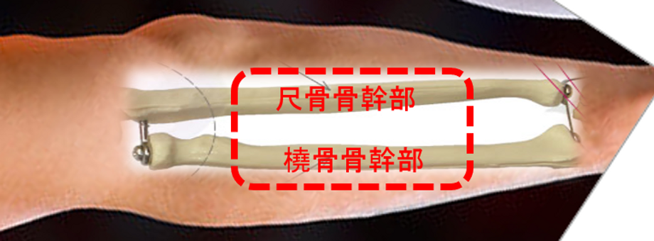 腕の骨折 骨癒合に時間がかかります 大人の場合は手術が必要です