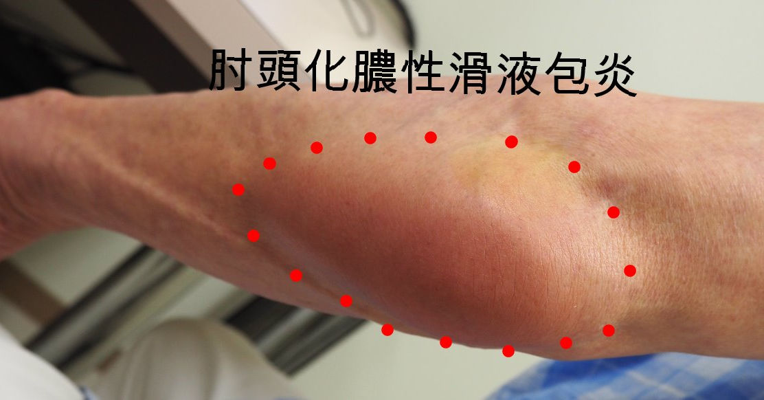 肩や肘が腫れて痛い 熱を伴って痛い 赤くなっている 肩や肘が腫れて痛い 熱を伴って痛い 赤くなっている