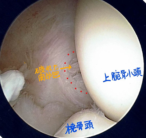 テニス肘重症例の内視鏡手術