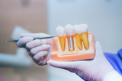 Dentist with tooth implant false teeth