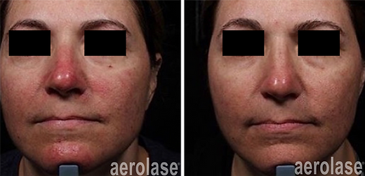 aerolase-neoskin-rosacea-1-week-after-1-treatment-one-aesthetics.png