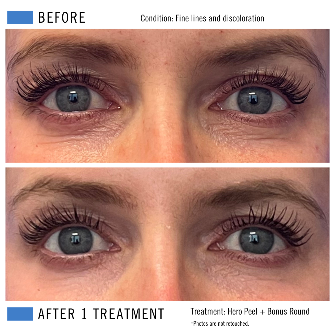 Hero Peel + Bonus Round.png