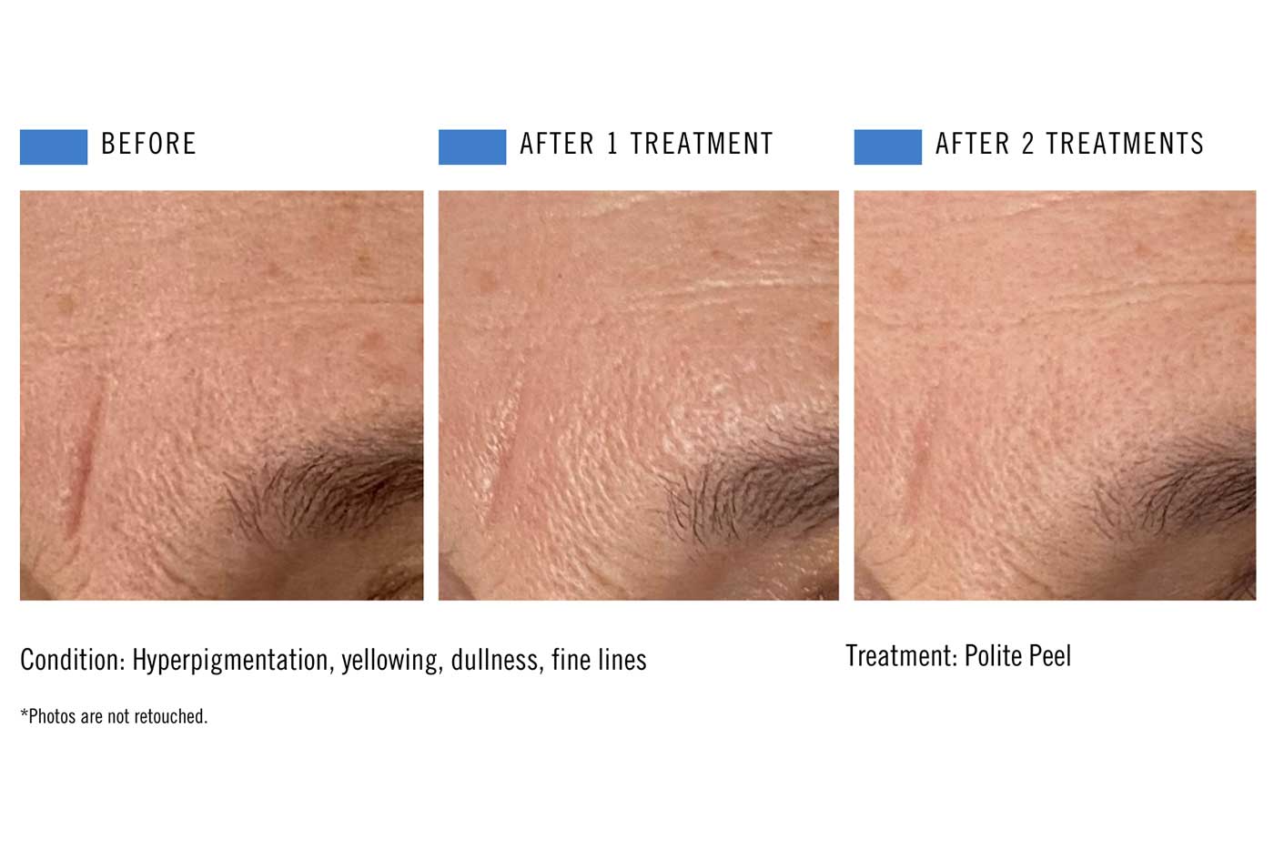 Polite Peel - Forehead -2-treatments.jpg