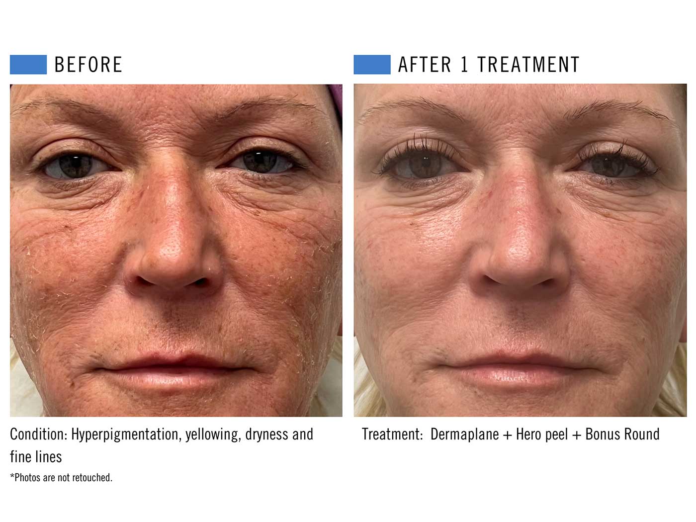 Hero + Dermaplane.jpg