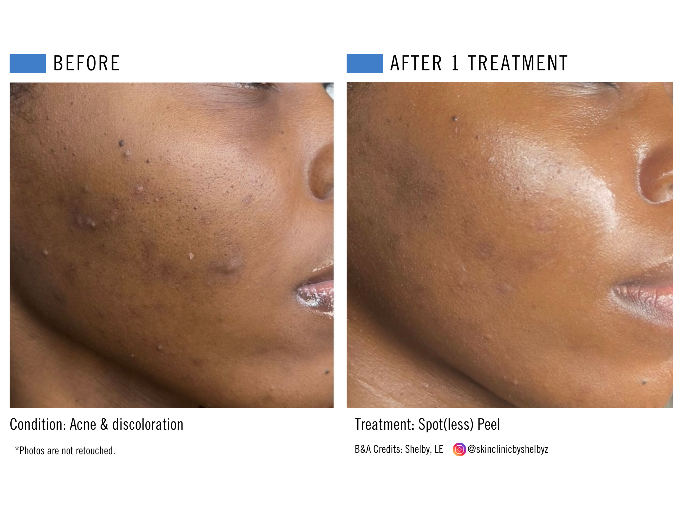 Spot(less) Peel (3).png