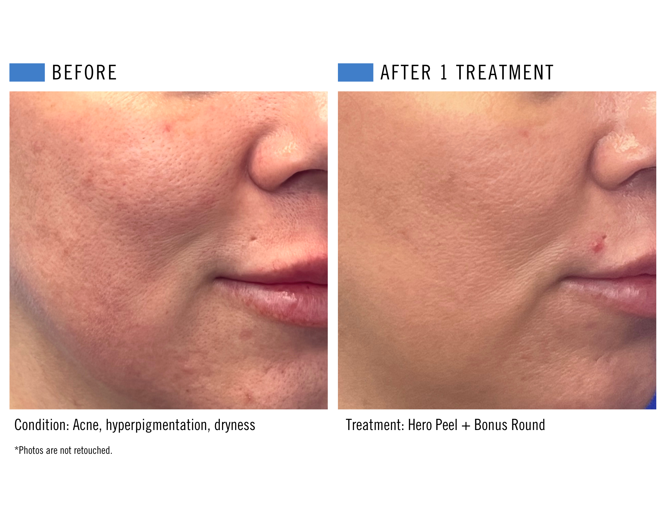 Hero Peel + Bonus Round (4).png