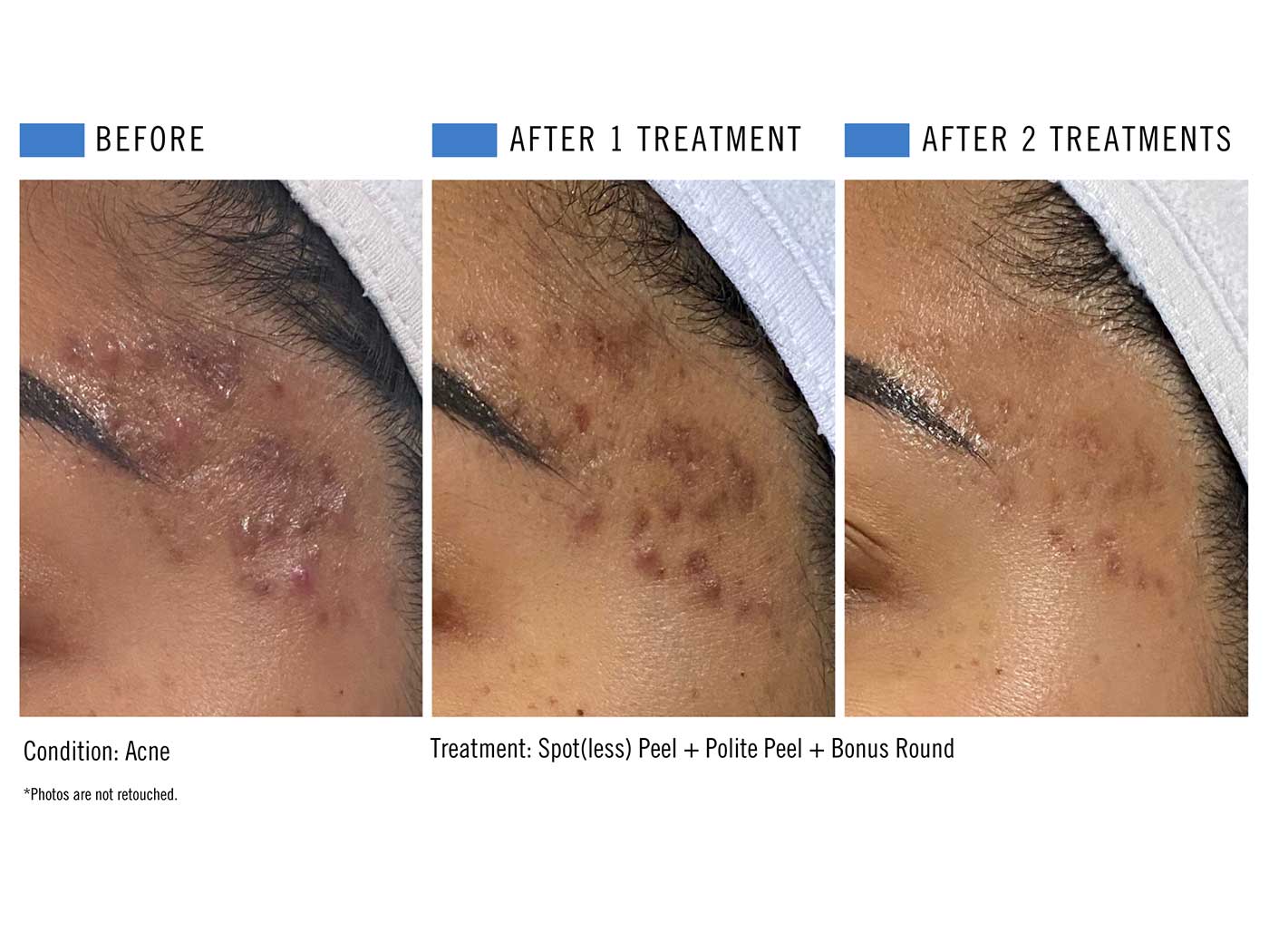 Spotless + Polite Peel - 1 & 2 Treatments.jpg