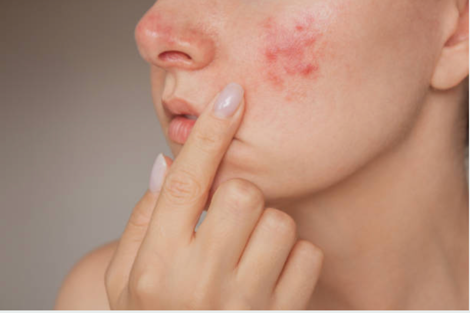 Close-up of a person touching red, irritated skin on their cheek, indicating acne or rash, set against a neutral background.