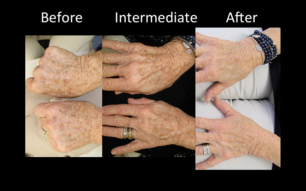 Sun spot removal