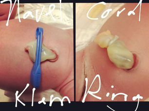 Cordring en (halve) lotusgeboorte
