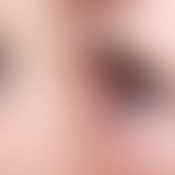 How to Combat Itchy Eyes this Summer