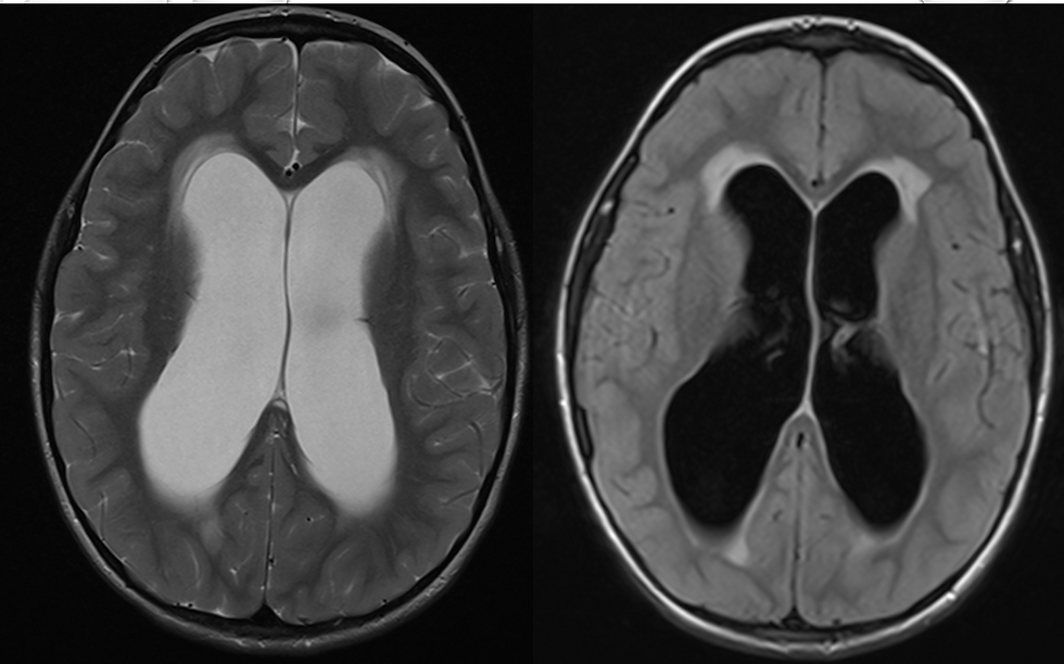 הידרוצפלוס (הידרוקון, מיימת הראש)