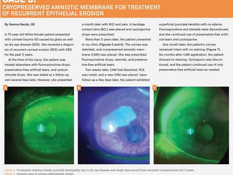 Guideline Redefines Amniotic Membrane’s Role in Ocular Surface Disease