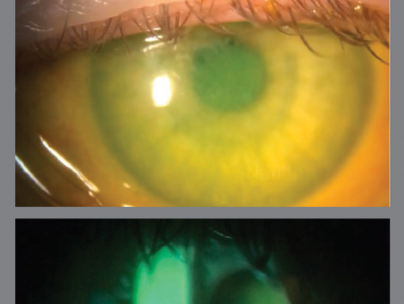 How to Address Dry Eye in the Challenging Cornea
