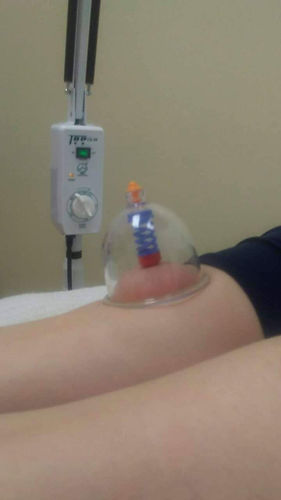 cupping-treatment-saskatoon-stoonrmt.jpe
