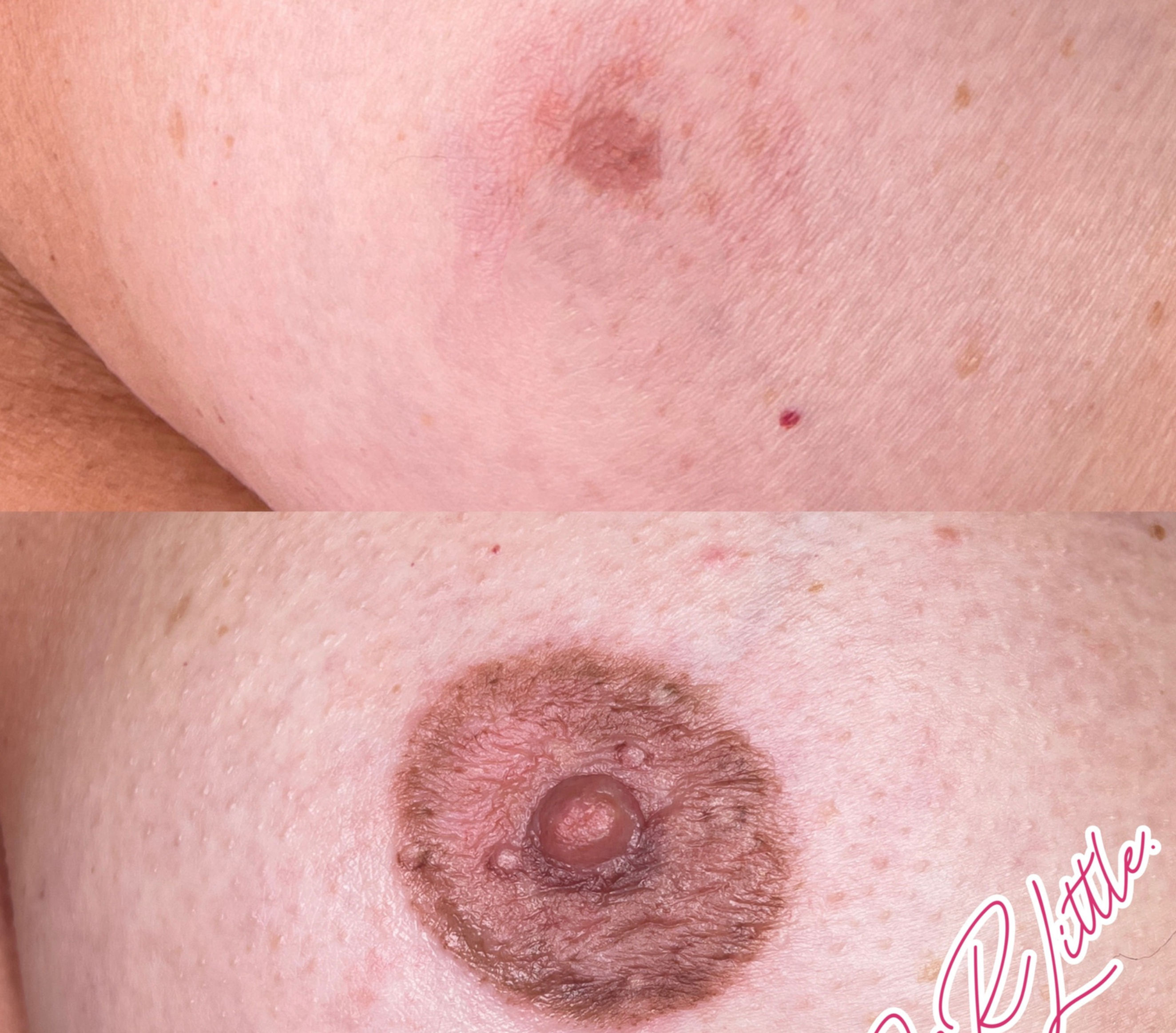 Post mastectomy areola tattoo