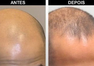 Microagulhamento capilar
