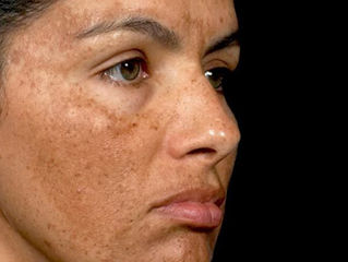O Melasma tem cura?