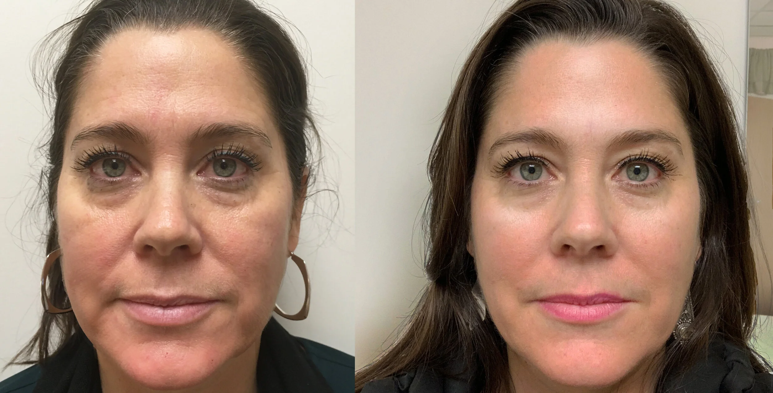 facial acupuncture before and after pictures