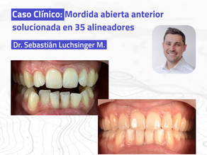Caso clínico: Mordida abierta anterior solucionada con 35 alineadores