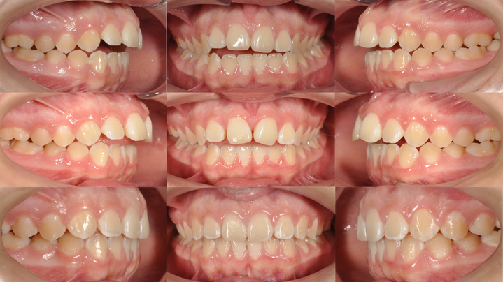 Caso clínico alineadores