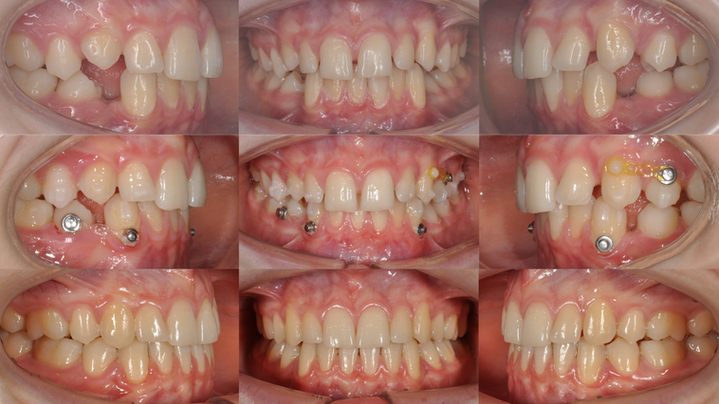 Caso clínico alineadores