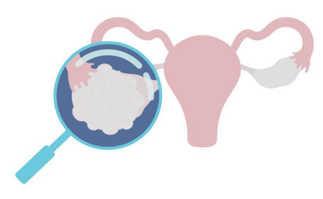 Une diététicienne-nutritionniste peut envisager le SOPK sous un autre angle que celui de la pilule