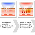 Microneedling_edited.jpg