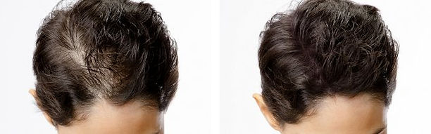 Scalp Micropigmentation | website