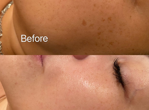 Freckle and sun spots removal