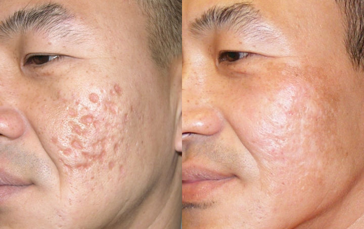 Acne Scars Treatment