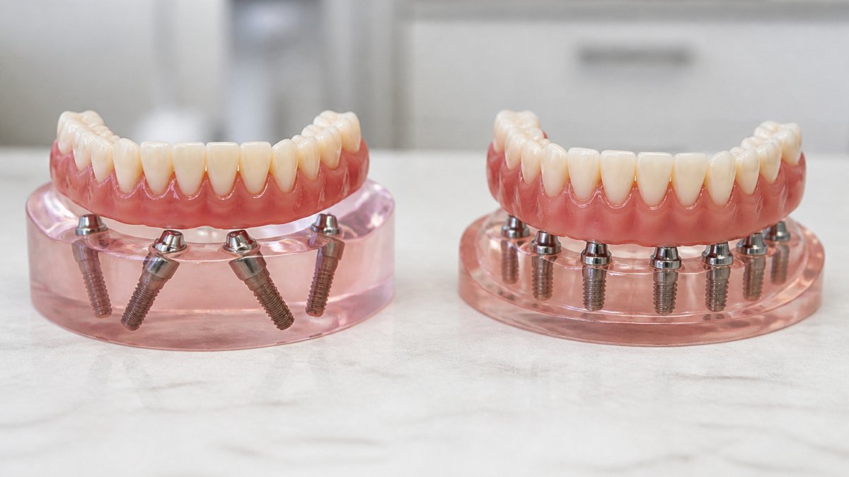 All-on-4 vs Full-Mouth Implants: A Complete Comparison